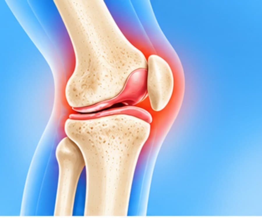 Illustration of a knee joint seen from the side, with the painful joint surfaces highlighted in red
