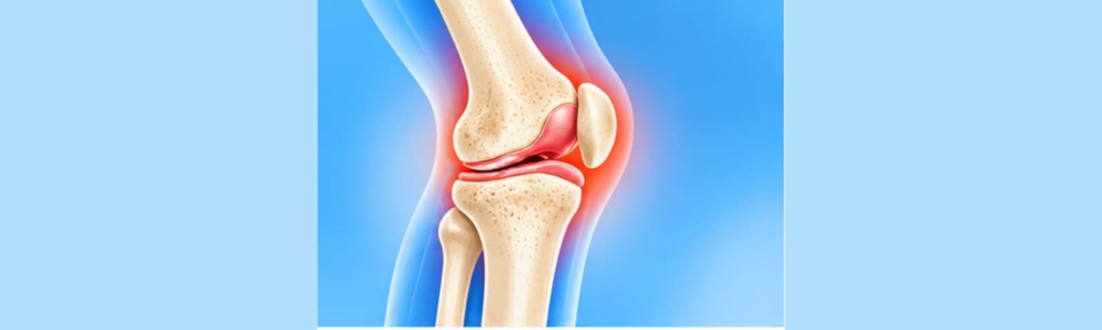 Illustration of a knee joint seen from the side, with the painful joint surfaces highlighted in red